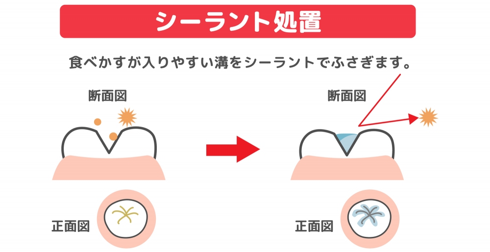 シーラント