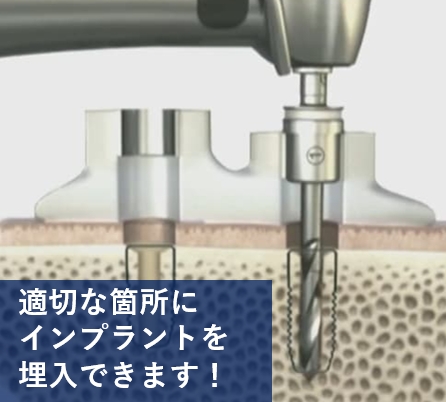 インプラントを正確な位置に埋入できる「サージカルガイド」を用いた安全への取り組み