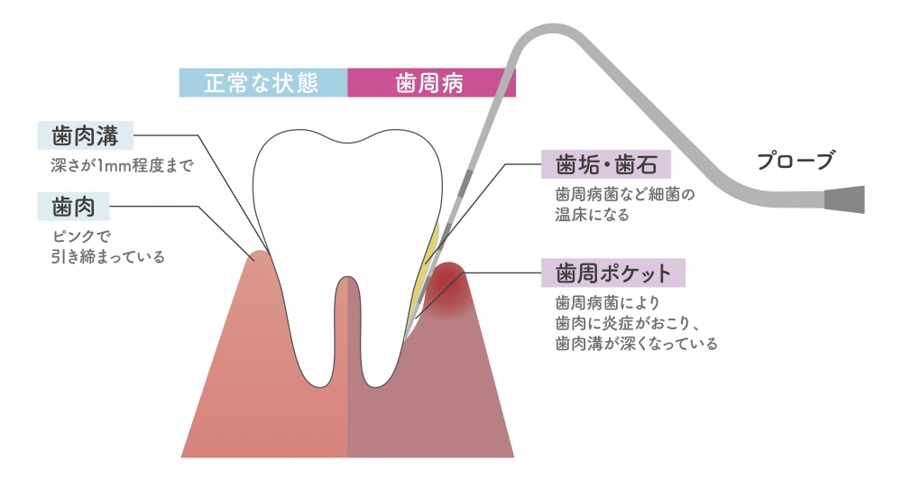 なぜ歯周病は抜歯になる可能性が高い？
