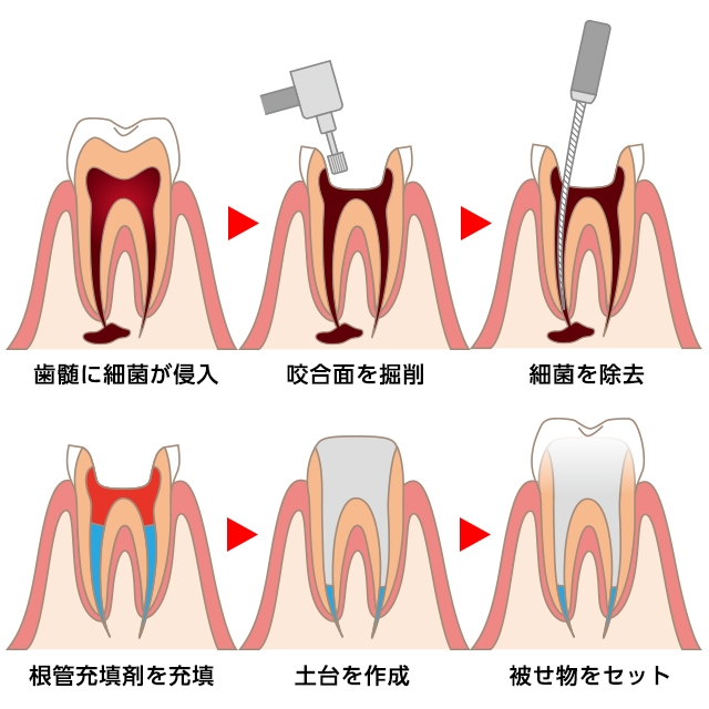 ご自身の歯を残す「根管治療」
